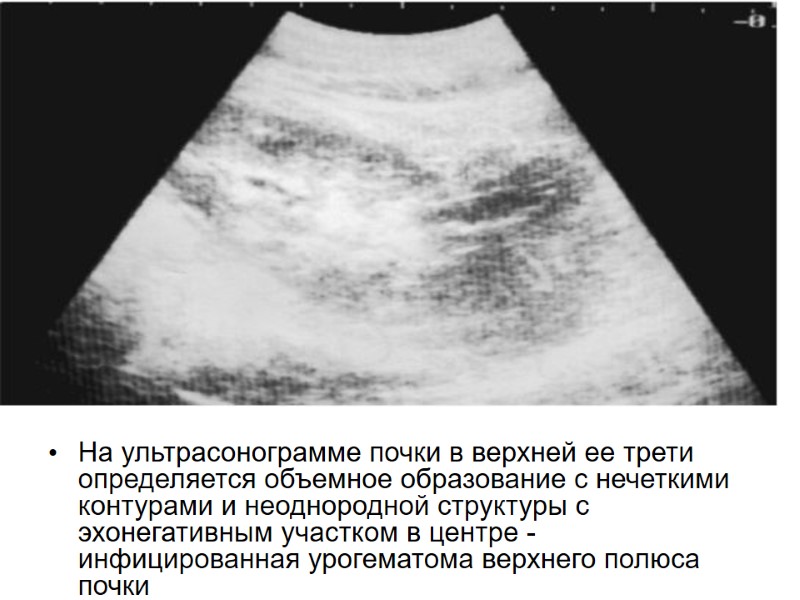На ультрасонограмме почки в верхней ее трети определяется объемное образование с нечеткими контурами и